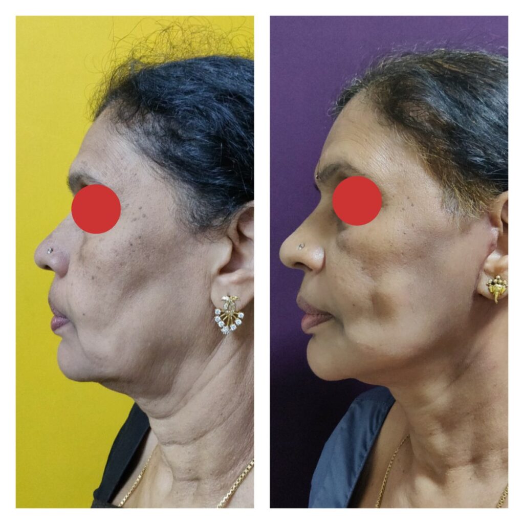 facial rejuvenation treatment at The Venkat Center