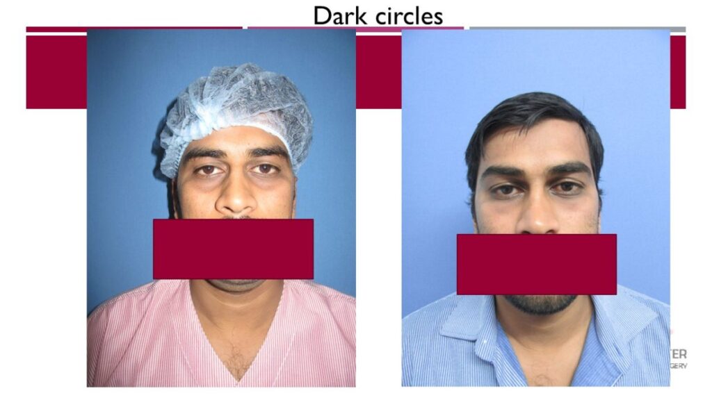 fat grafting for dark circles at venkat center
