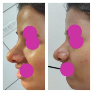 filler rhinoplasty