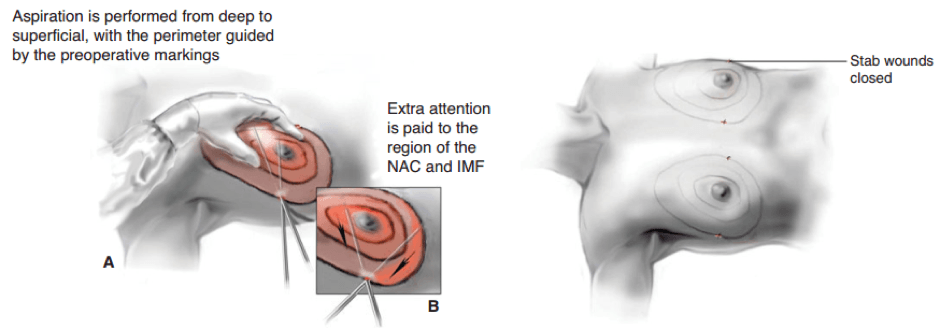 Gynecomastia treatment pictorial representation