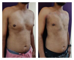 Gynaecomastia Treatment at Venkat Center