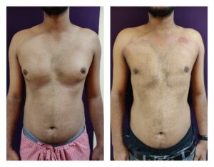 Gynaecomastia Treatment at Venkat Center