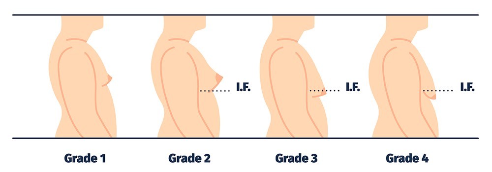 Gynecomastia Surgery 48 Gynecomastia Surgery 1