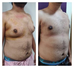 Gynaecomastia Treatment at Venkat Center