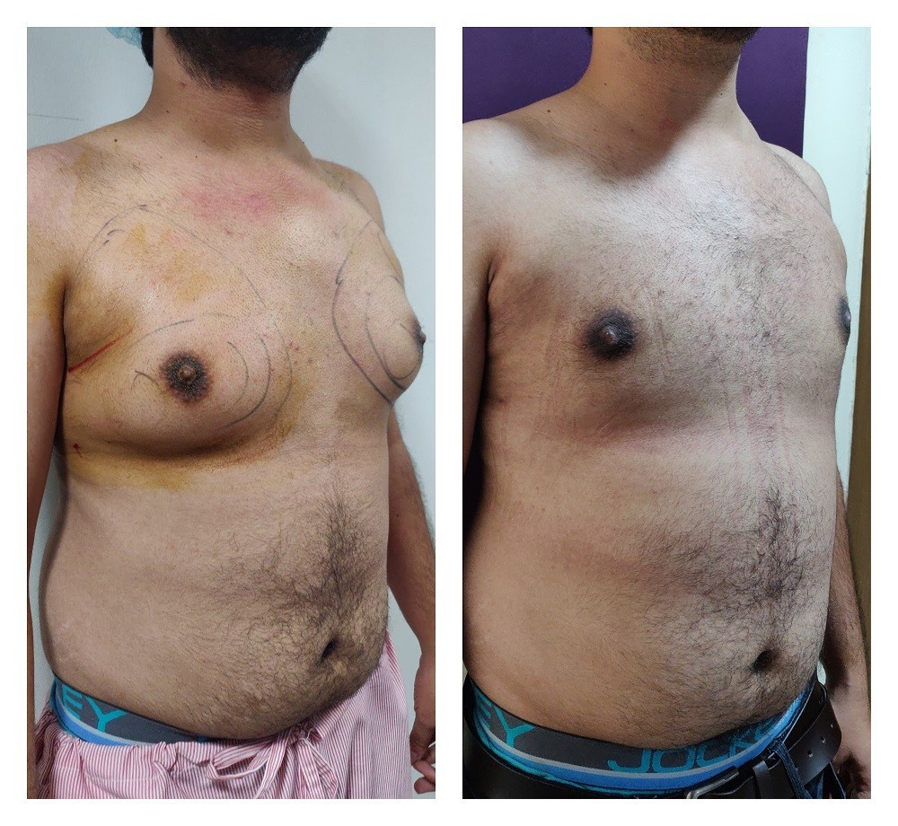 Gynecomastia Surgery Cost In Bangalore, India