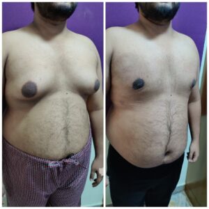 Gynecomastia Surgery 2