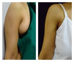 Liposuction in women at The Venkat Center