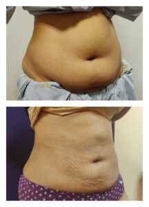Liposuction in women at The Venkat Center