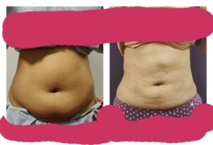 Liposuction in women at The Venkat Center