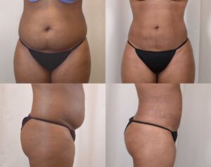 Liposuction in women at The Venkat Center