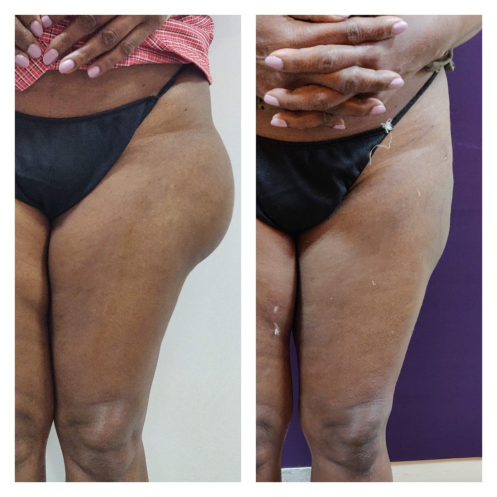 Liposuction in women at The Venkat Center