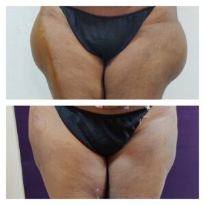 Liposuction in women at The Venkat Center