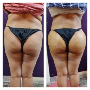 Liposuction in women at The Venkat Center