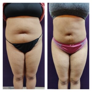 Liposuction in women at The Venkat Center