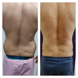 liposuction patients at The Venkat Center