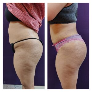 liposuction patients at The Venkat Center