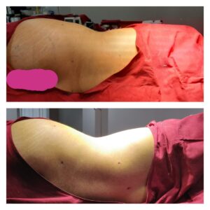 liposuction patients at The Venkat Center
