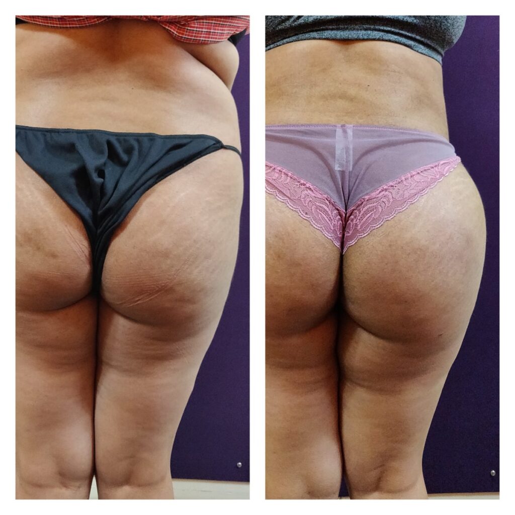 liposuction patients at The Venkat Center