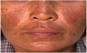 Melasma - at Venkat Center, Bangalore