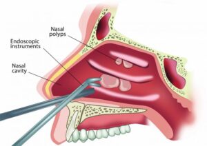 Nasal polyps treatment - at Venkat Center, Bangalore