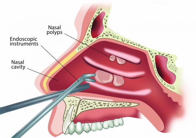 Nasal Polyps Treatment at The Venkat Center