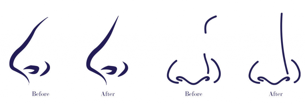 nonsurgical rhinoplasty