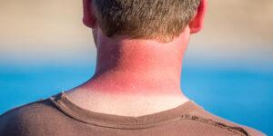 sun exposure skin problems