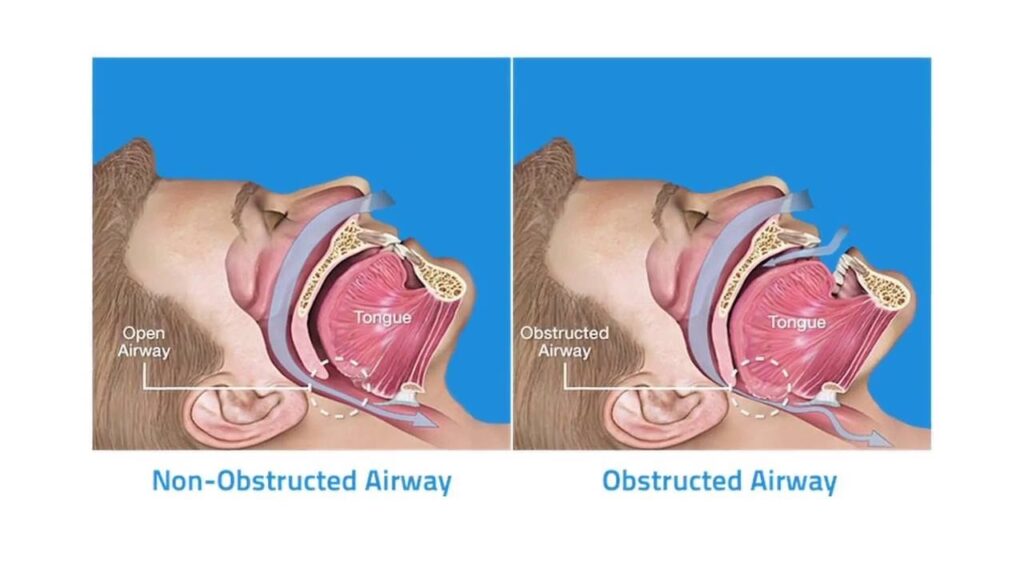 Laser Snoring Treatment 2