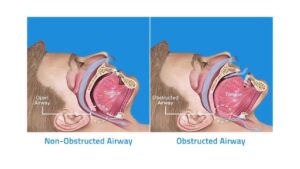 laser treatment for snoring