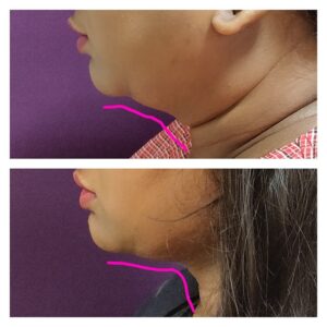 Double Chin Treatment at The Venkat Center