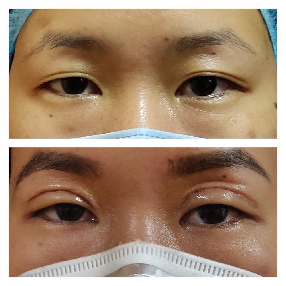 double eyelid surgery