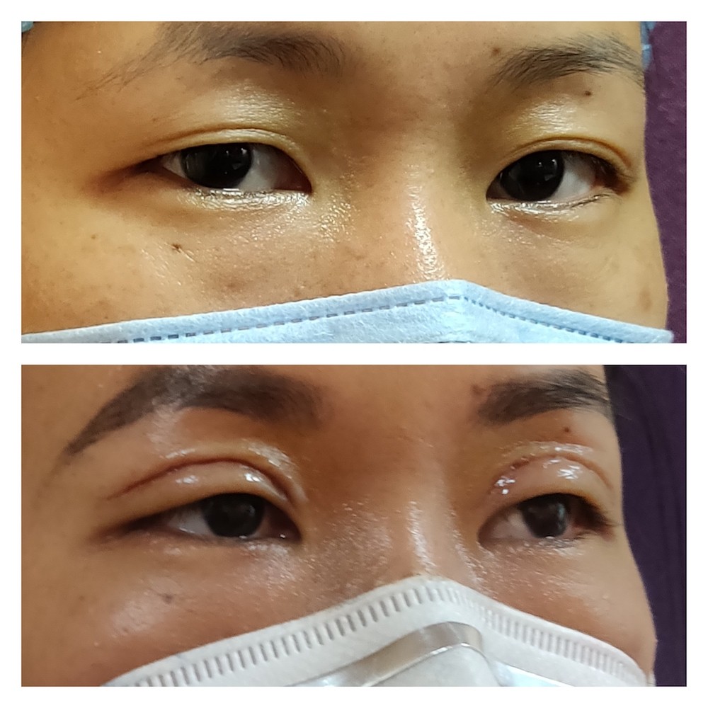 Asian Blepharoplasty surgery at Venkat Center, Bangalore