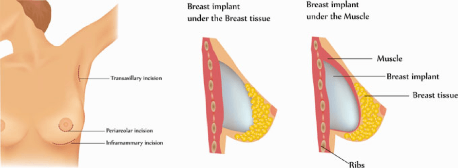 Placements of The Breast Implants