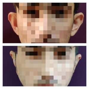 prominent-ear-correction-surgery-cost-1