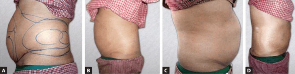 Results after combination of liposuction and lipolysis.