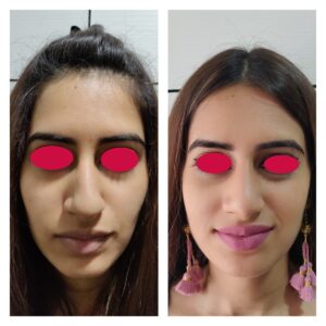 rhinoplasty patients from the venkat center