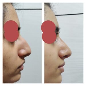 rhinoplasty patients from the venkat center