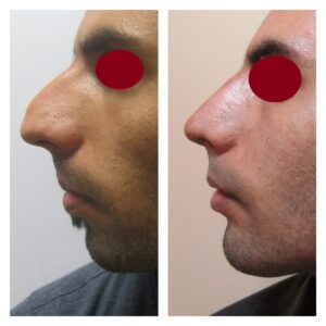 rhinoplasty patients from the venkat center