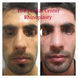 rhinoplasty patients from the venkat center