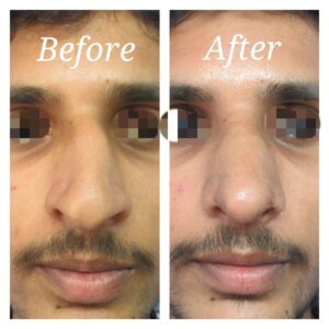 rhinoplasty patients from the venkat center