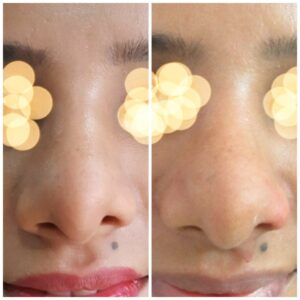 rhinoplasty patients from the venkat center