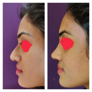 rhinoplasty patients from the venkat center