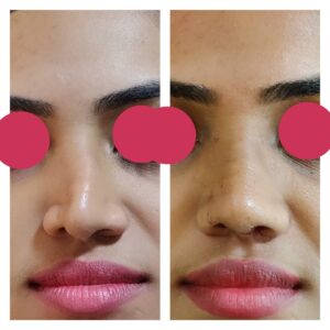 rhinoplasty patients from the venkat center