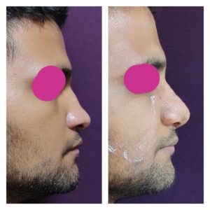 rhinoplasty patients from the venkat center
