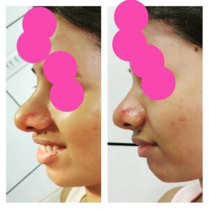 rhinoplasty patients from the venkat center