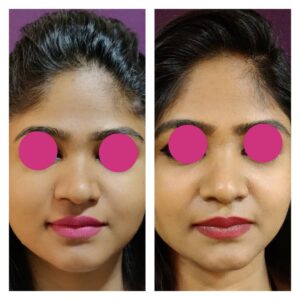 rhinoplasty patients from the venkat center