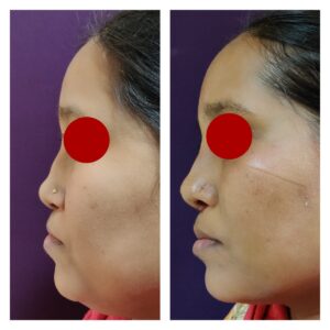 rhinoplasty patients from the venkat center