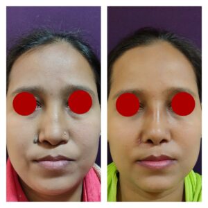 rhinoplasty patients from the venkat center