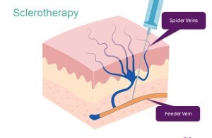 Best Sclerotherapy treatments of varicose veins bangalore
