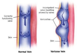 Varicose veins treatment at Venkat Center, Bangalore